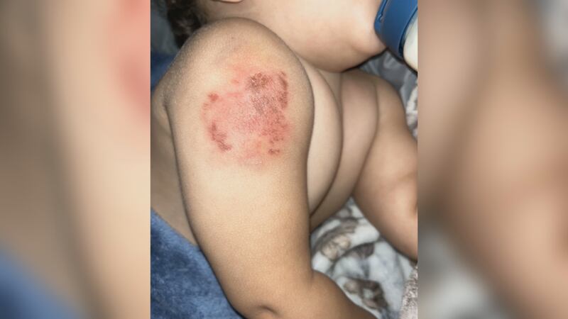 Child bit at Central Texas Children's Center in Temple