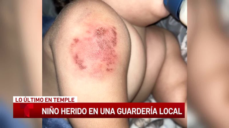 Un niño pequeño de Temple fue mordido varias veces en la guardería, y su madre afirma que el...